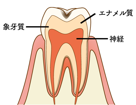 虫歯の進行