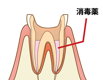 根管貼薬
